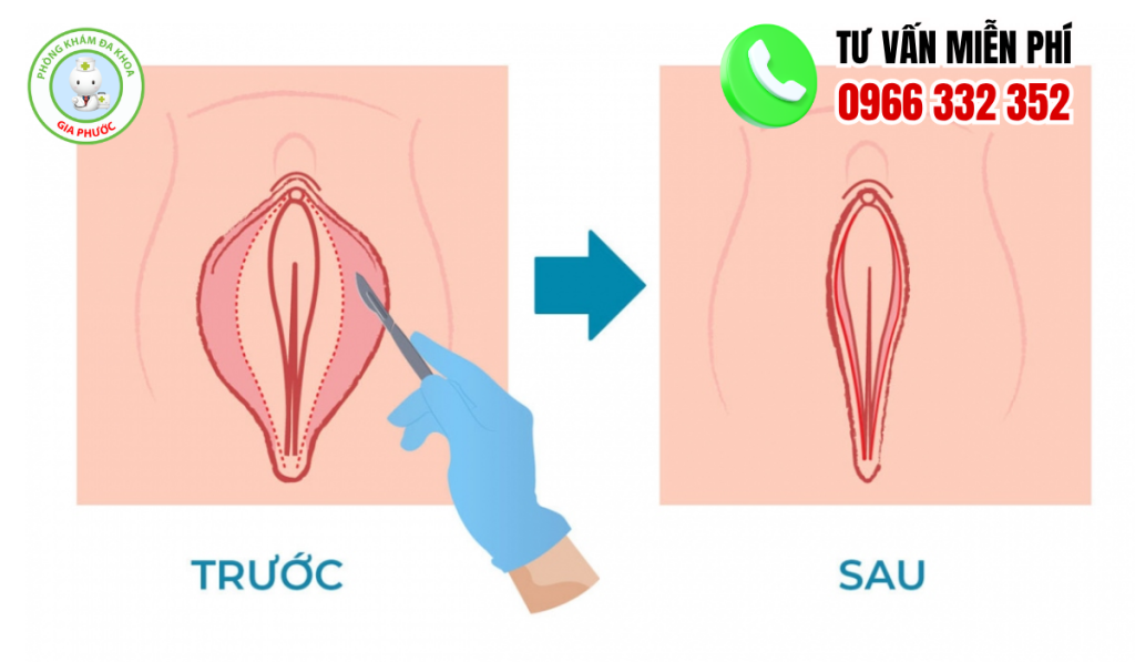 hình ảnh trước và sau khi cắt môi bé