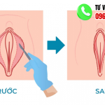 hình ảnh trước và sau khi cắt môi bé