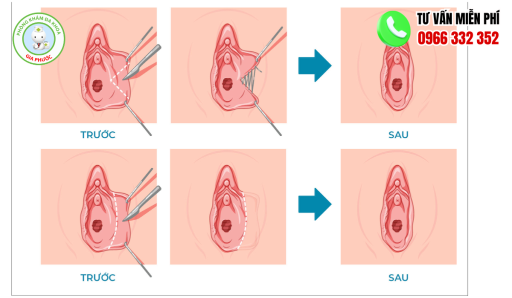 Hình ảnh trước và sau khi cắt môi bé thẩm mỹ