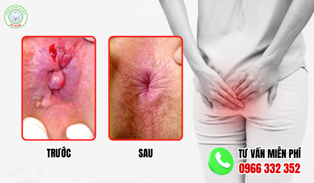 Hình ảnh trước và sau khi cắt trĩ