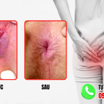 Hình ảnh trước và sau khi cắt trĩ