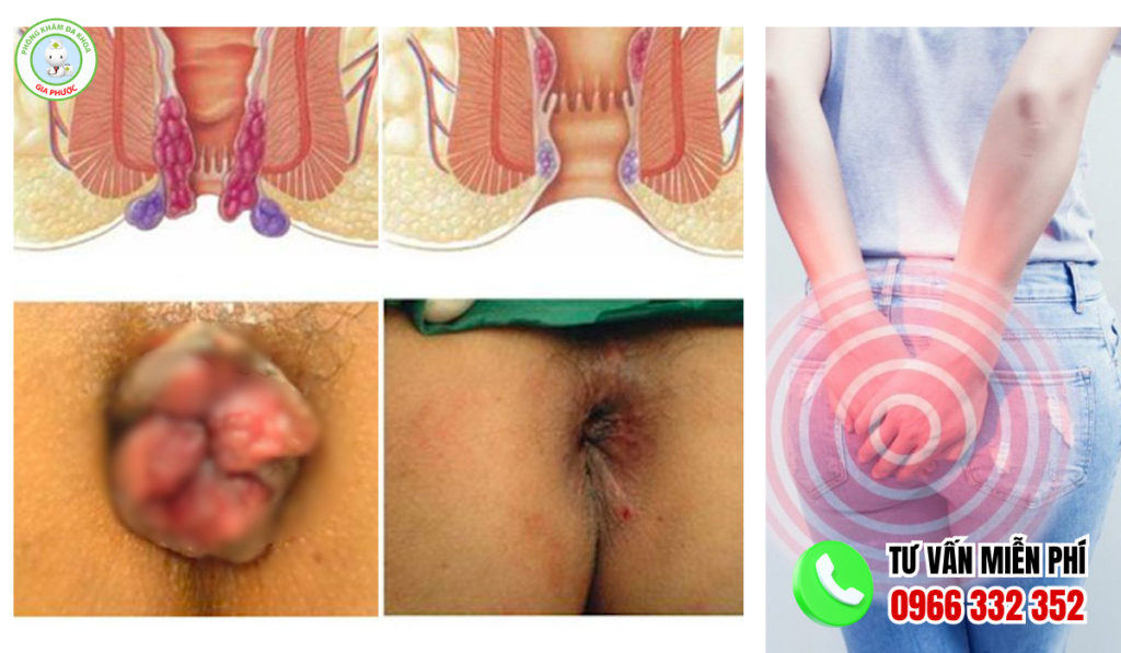 Hình ảnh trước và sau khi cắt trĩ