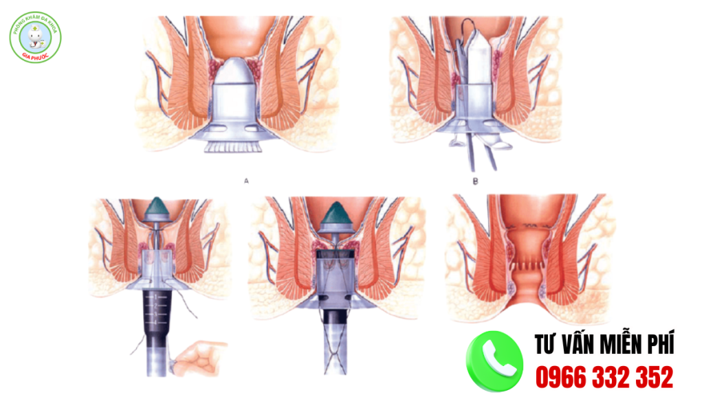 Hình ảnh trước và sau khi cắt trĩ