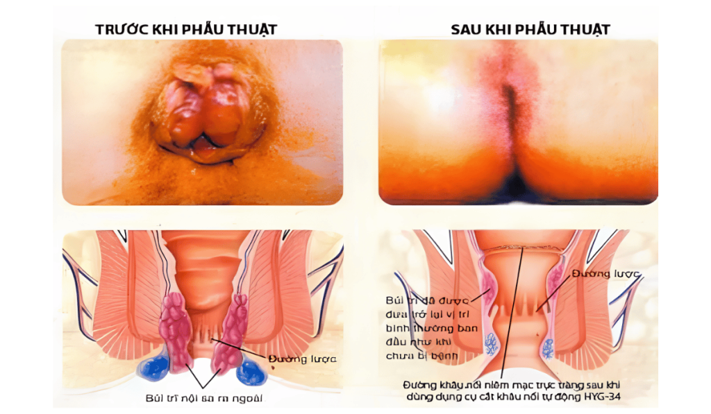 Hình Ảnh Trước Và Sau Khi Cắt Trĩ