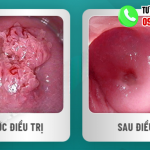 Hình ảnh trước và sau khi điều trị sùi mào gà