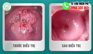 Hình ảnh trước và sau khi điều trị sùi mào gà