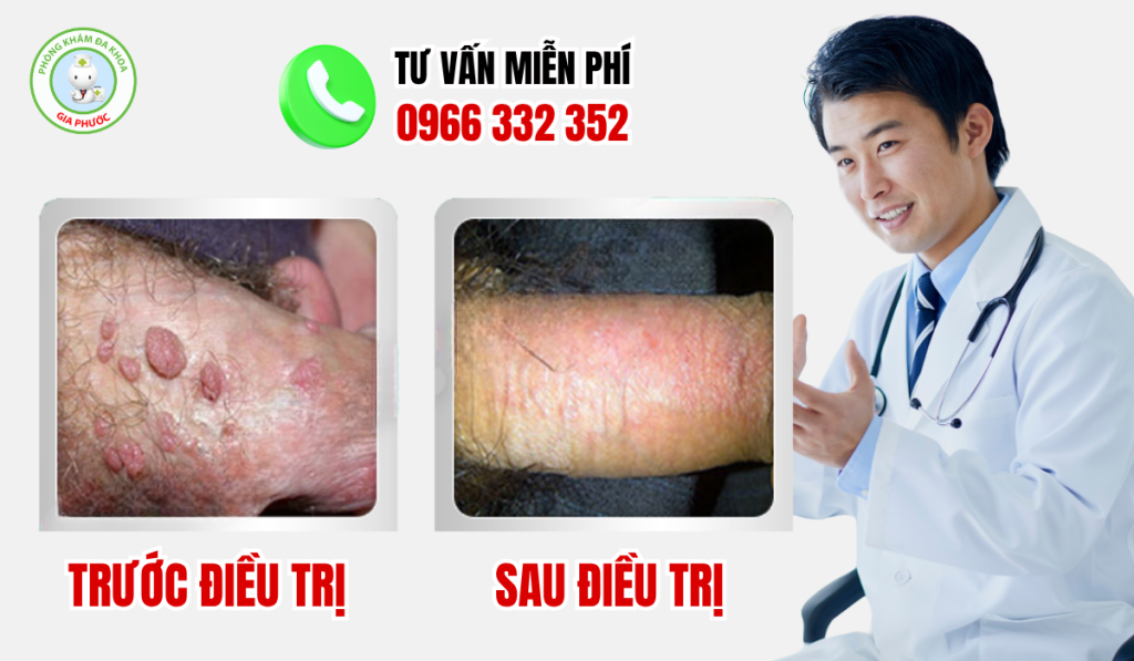 Hình Ảnh Trước Và Sau Khi Điều Trị Sùi Mào Gà Ở Nam Và Nữ 4 Hình ảnh trước và sau khi điều trị sùi mào gà