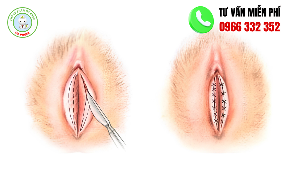 Hình Ảnh Trước Và Sau Phẫu Thuật Cô Bé
