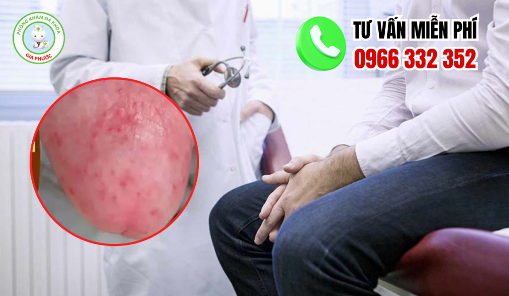 Hình Ảnh Viêm Bao Quy Đầu Ở Người Lớn Chân Thật Và Cách Xử Lý 1 Hình ảnh viêm bao quy đầu ở người lớn
