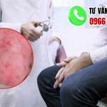 Hình ảnh viêm bao quy đầu ở người lớn