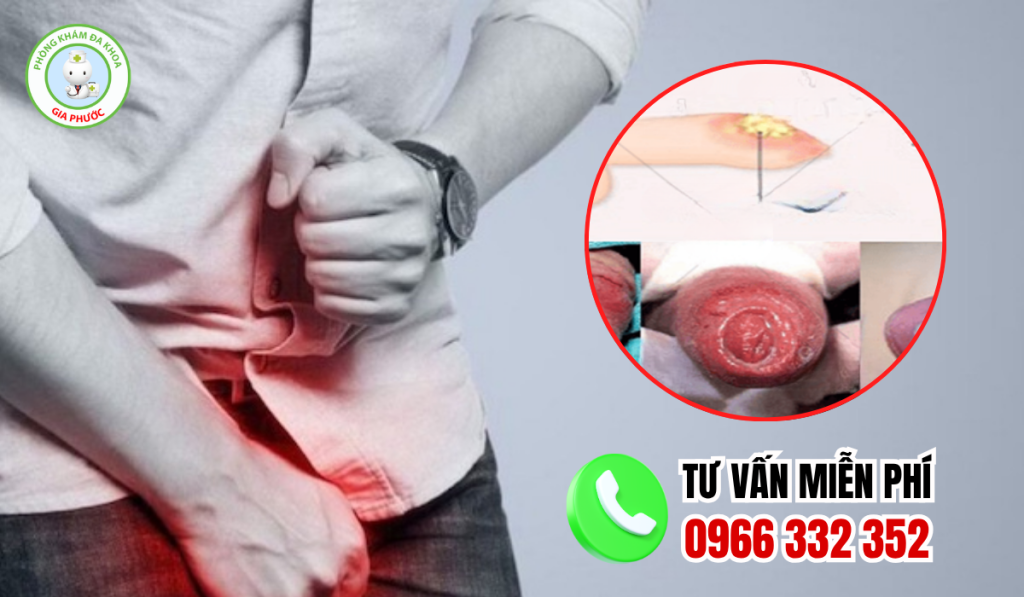 Hình Ảnh Viêm Bao Quy Đầu Ở Người Lớn Chân Thật Và Cách Xử Lý 4 Hình ảnh viêm bao quy đầu ở người lớn