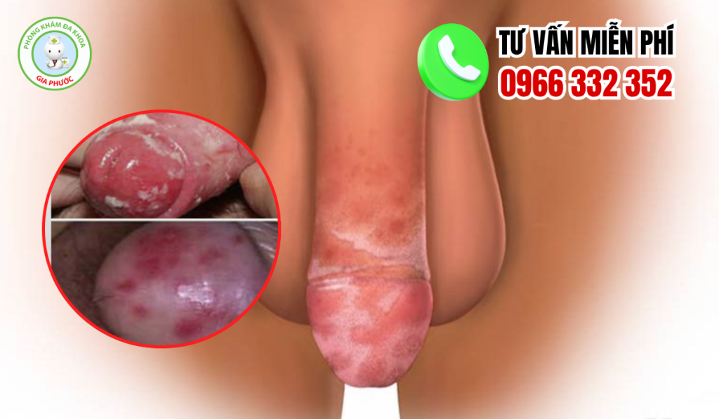 Hình Ảnh Viêm Bao Quy Đầu Ở Người Lớn Chân Thật Và Cách Xử Lý 3 Hình ảnh viêm bao quy đầu ở người lớn
