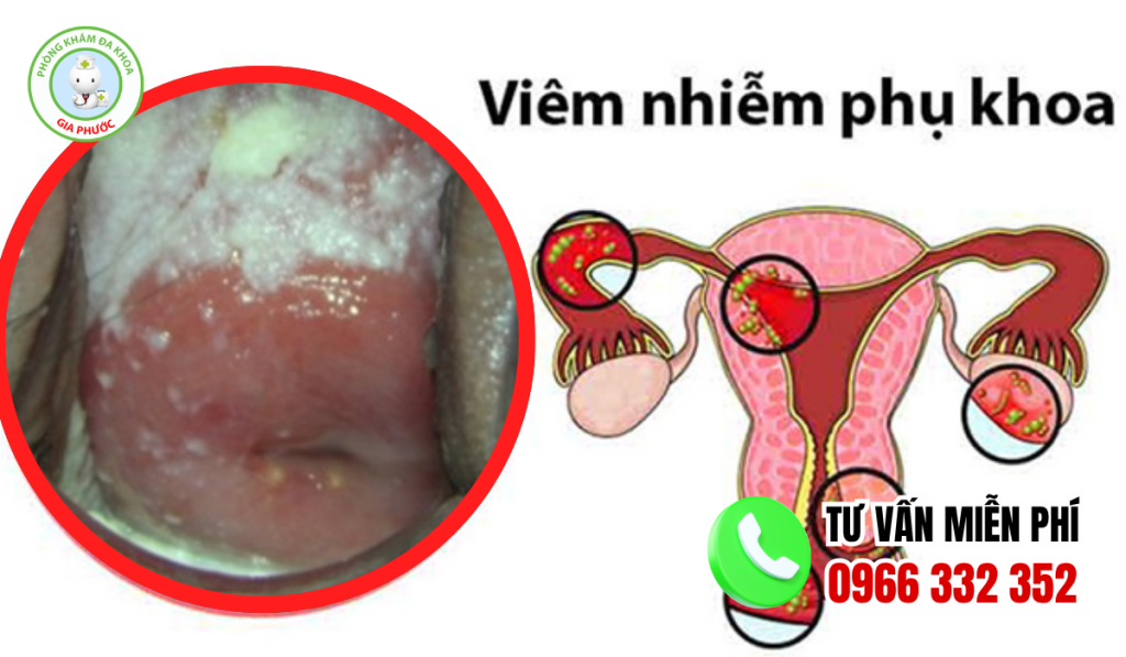 Hình Ảnh Viêm Phụ Khoa Ở Nữ Giới Và Cách Điều Trị Dứt Điểm 3 Hình ảnh viêm phụ khoa nữ giới
