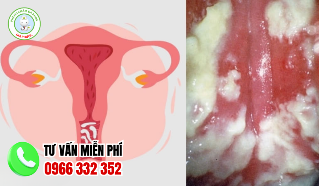 Hình Ảnh Viêm Phụ Khoa Ở Nữ Giới Và Cách Điều Trị Dứt Điểm 4 Hình ảnh viêm phụ khoa nữ giới