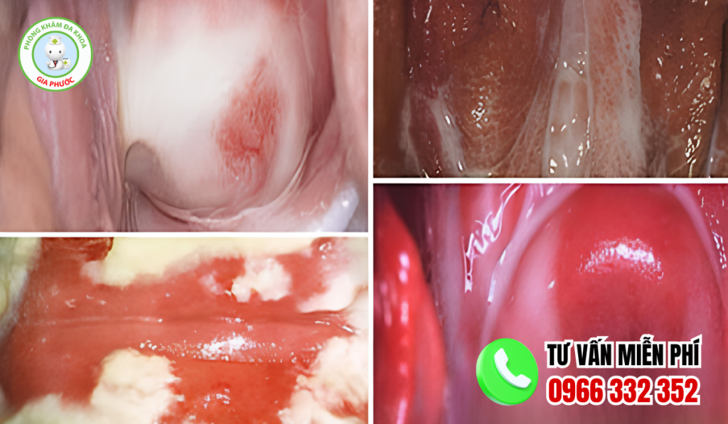 Hình Ảnh Viêm Phụ Khoa Ở Nữ Giới Và Cách Điều Trị Dứt Điểm 5 Hình ảnh viêm phụ khoa nữ giới