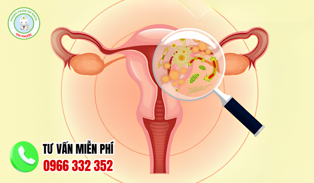 Hình Ảnh Viêm Phụ Khoa Ở Nữ Giới Và Cách Điều Trị Dứt Điểm 1 Hình Ảnh Viêm Phụ Khoa Ở Nữ Giới Và Cách Điều Trị Dứt Điểm