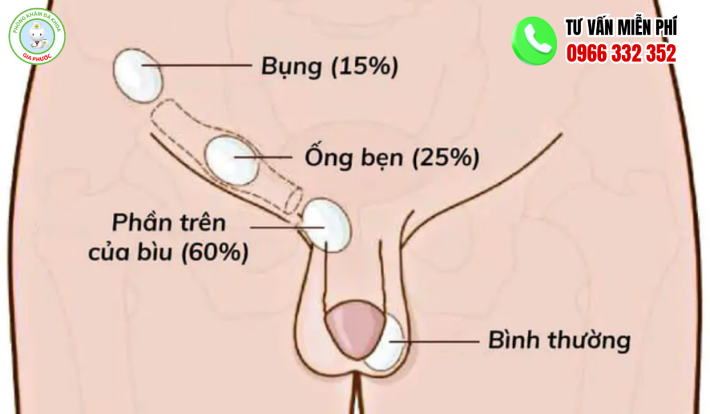 Cảnh Báo Các Hình Ảnh Biến Chứng Tinh Hoàn Bất Thường Ở Trẻ