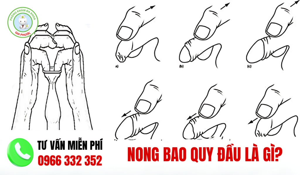 50 Hình Ảnh Sau Khi Nong Bao Quy Đầu Và Cách Chăm Sóc 2 hình ảnh sau khi nong bao quy đầu