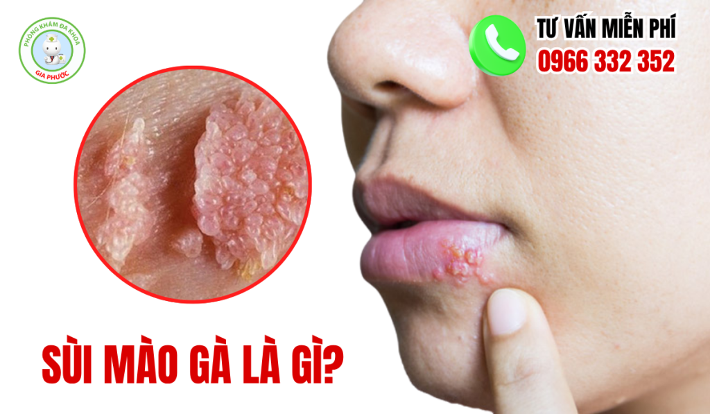 Hình Ảnh Trước Và Sau Khi Điều Trị Sùi Mào Gà Ở Nam Và Nữ 2 Sùi mào gà là gì