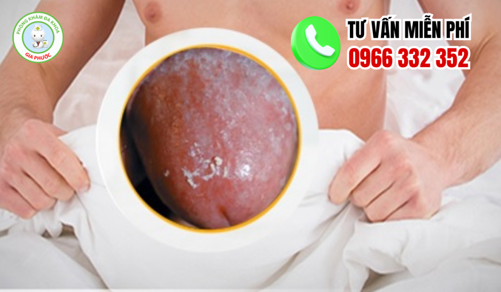 Hình Ảnh Viêm Bao Quy Đầu Ở Người Lớn Chân Thật Và Cách Xử Lý 2 Hình ảnh viêm bao quy đầu ở người lớn
