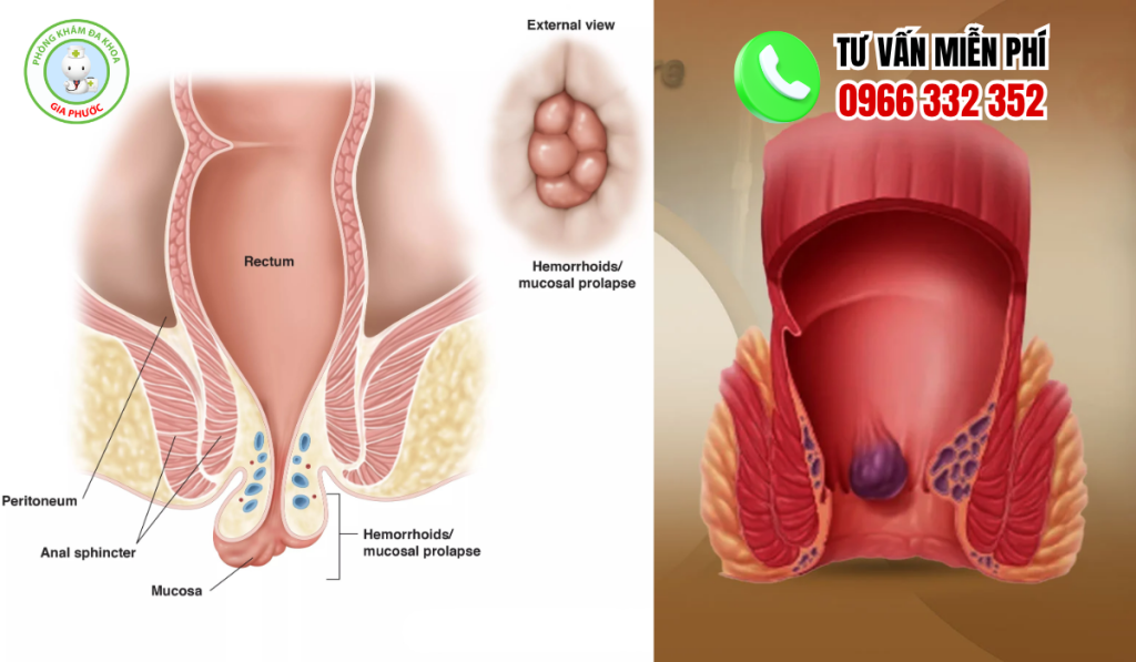 hình ảnh bệnh trĩ ngoại