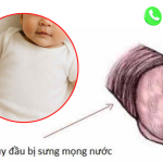 Bao quy đầu bị sưng mọng nước ở trẻ nhỏ