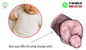 Bao quy đầu bị sưng mọng nước ở trẻ nhỏ