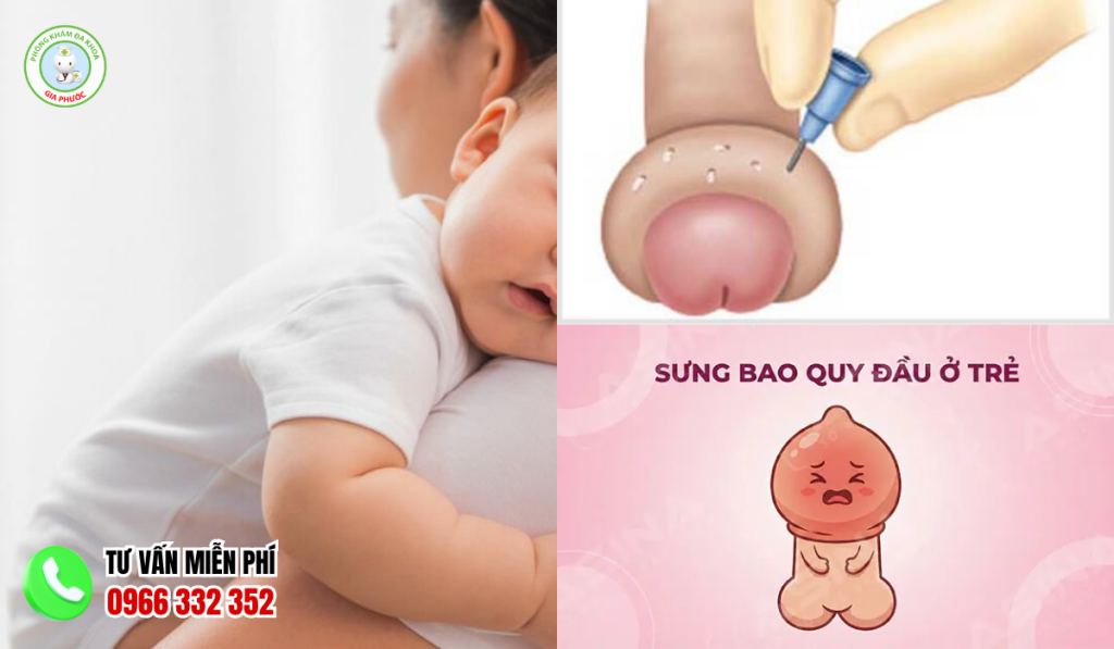 Bao Quy Đầu Bị Sưng Mọng Nước Ở Trẻ Nhỏ: Nguyên Nhân Và Cách Trị 2 Bao quy đầu bị sưng mọng nước ở trẻ nhỏ