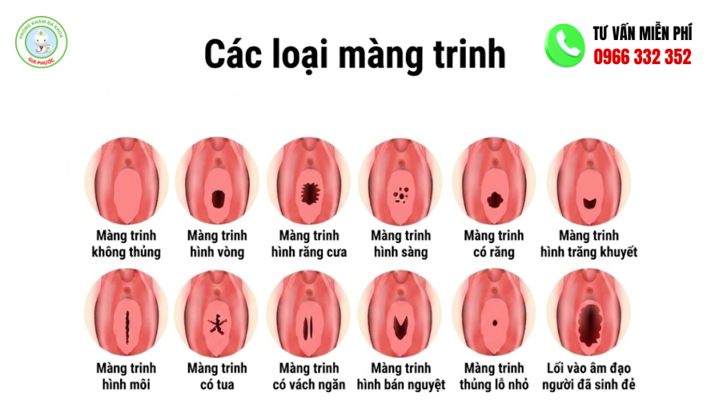 Màng Trinh Là Gì? Màng Trinh Nằm Ở Đâu? Cách Nhận Biết Còn Và Mất Trinh 4 Các loại màng trinh