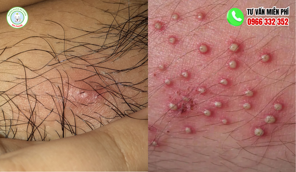 Các loại mụn ở vùng kín nam và nữ
