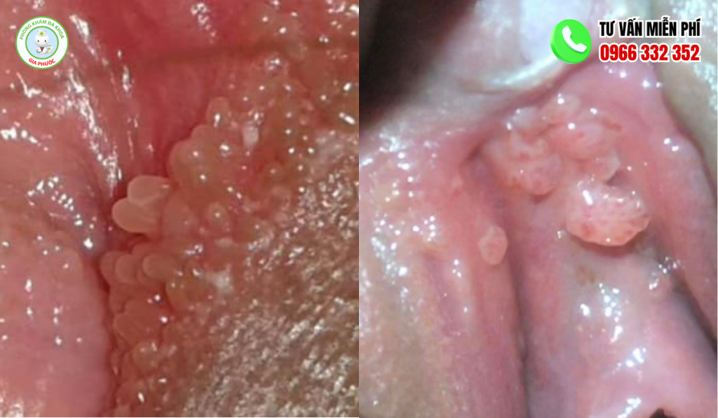 Các loại mụn ở vùng kín nam và nữ