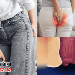 Dấu hiệu bệnh trĩ ở phụ nữ