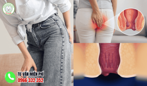 Dấu hiệu bệnh trĩ ở phụ nữ