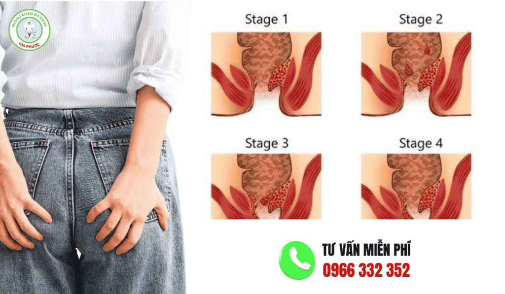 Bệnh Trĩ Ở Phụ Nữ: Hình Ảnh, Dấu Hiệu Và Cách Trị 4 Hình ảnh bệnh trĩ ở phụ nữ