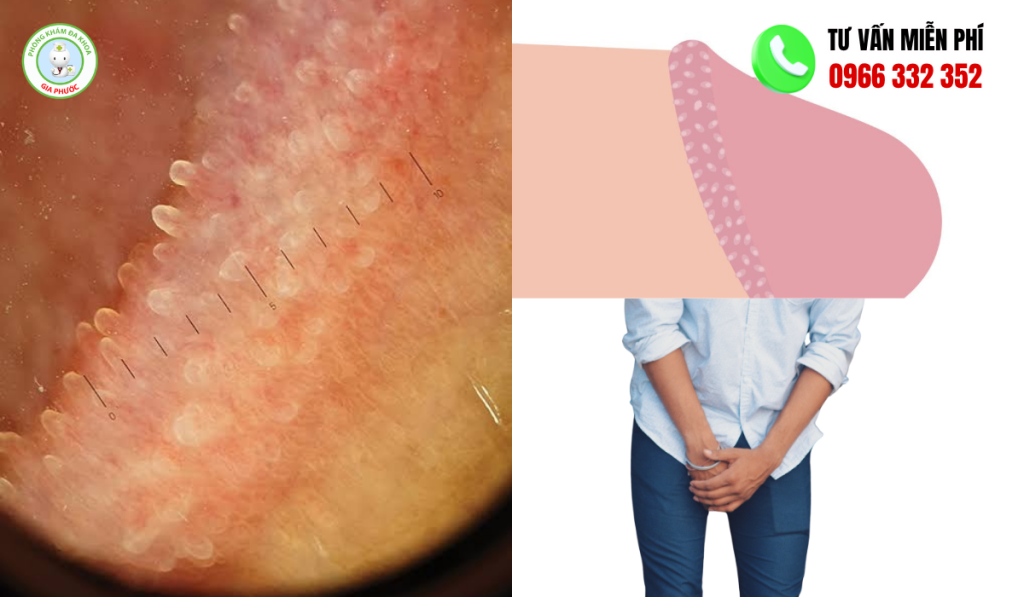 50+ Hình Ảnh Chuỗi Hạt Ngọc Dương Vật Ở Nam Giới 1 Hình ảnh chuỗi hạt ngọc dương vật ở nam giới