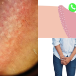 Hình ảnh chuỗi hạt ngọc dương vật ở nam giới