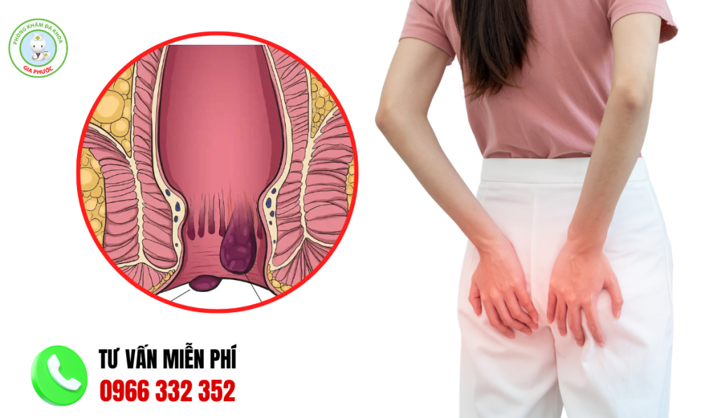 Hình Ảnh Thịt Thừa Ở Hậu Môn: Nhận Biết Triệu Chứng Và Cách Trị 4 Hình ảnh thịt thừa ở hậu môn
