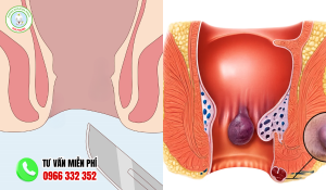 Hình ảnh hậu môn bình thường và hậu môn bị trĩ