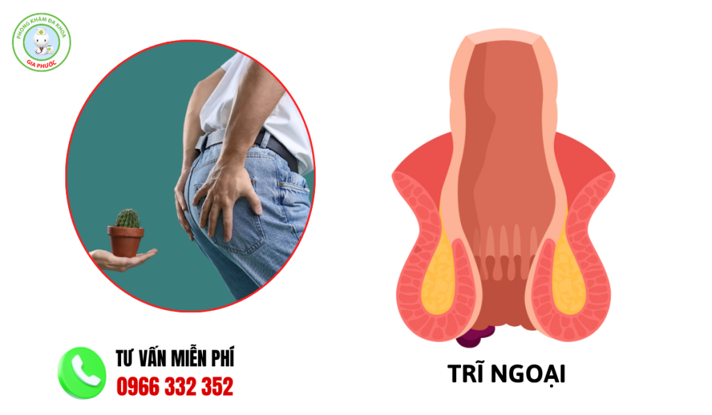 Hình ảnh hậu môn bình thường và hậu môn bị trĩ