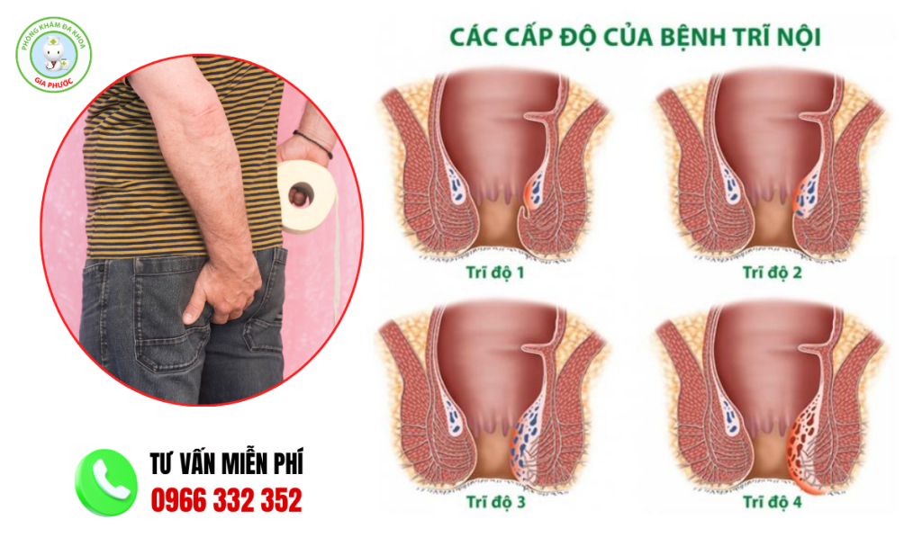Hình ảnh hậu môn bình thường và hậu môn bị trĩ