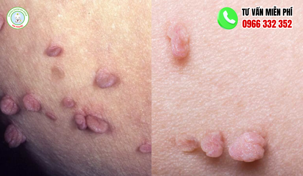 Hình ảnh mụn gai sinh dục nam