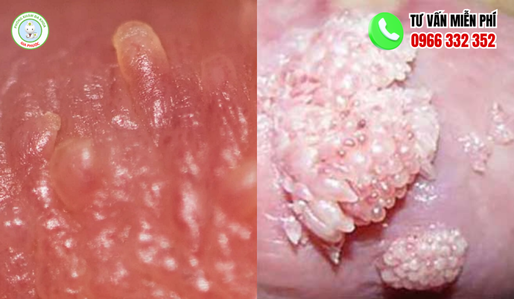 Hình ảnh mụn gai sinh dục nam