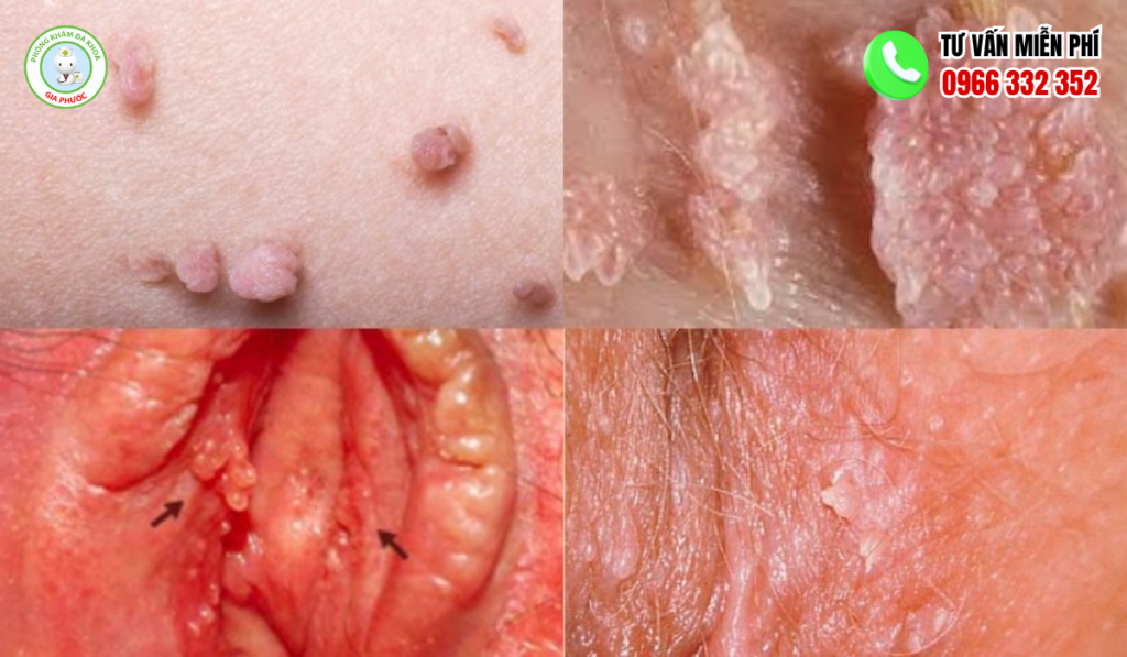 Hình ảnh nổi mụn ở mép vùng kín nữ
