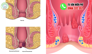 Hình ảnh thịt thừa ở hậu môn