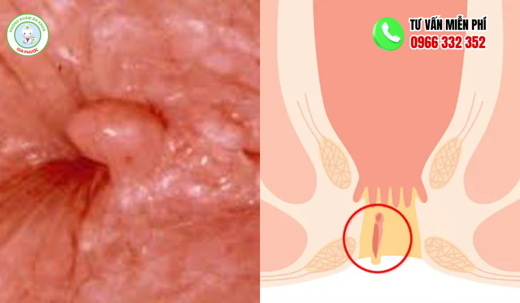 Hình Ảnh Thịt Thừa Ở Hậu Môn: Nhận Biết Triệu Chứng Và Cách Trị 3 Hình ảnh thịt thừa ở hậu môn
