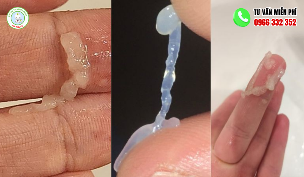 Hình Ảnh Tinh Trùng Vô Sinh Và Cách Điều Trị Chuẩn Y Khoa 4 Hình ảnh tinh trùng vô sinh