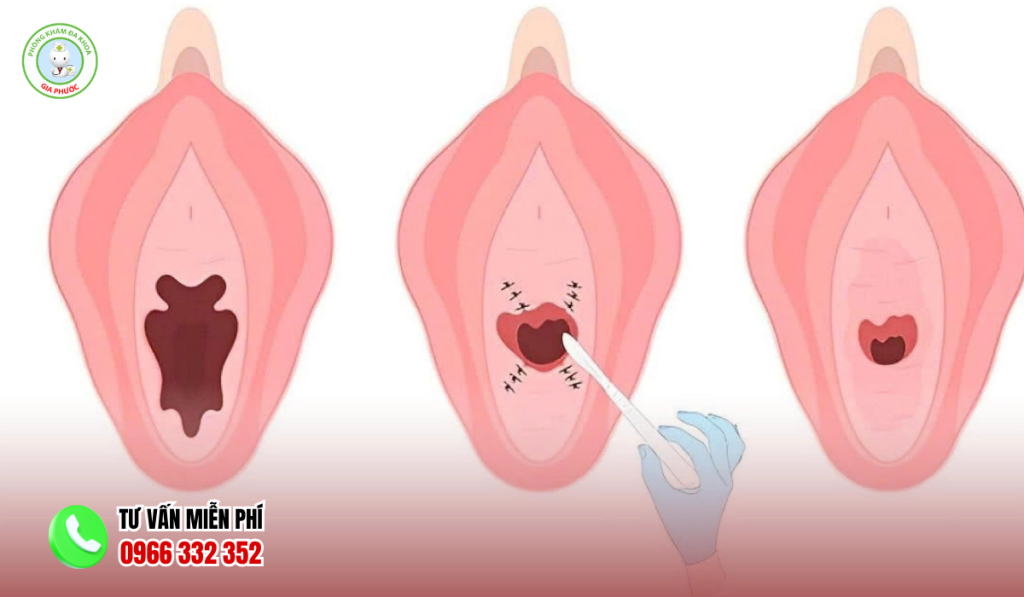 Lợi ích vá màng trinh là gì