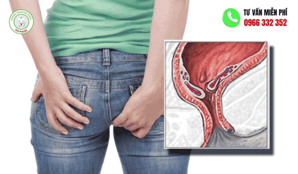 Bệnh Trĩ Ở Phụ Nữ: Hình Ảnh, Dấu Hiệu Và Cách Trị 3 Dấu hiệu bệnh trĩ ở phụ nữ