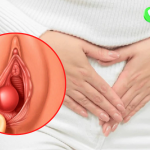 Hình ảnh nổi mụn ở mép vùng kín nữ