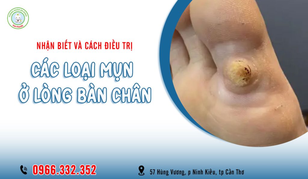 Cách điều trị các loại mụn ở lòng bàn chân